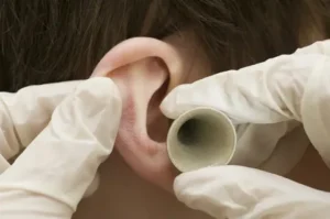 Fungal Ear Infections
